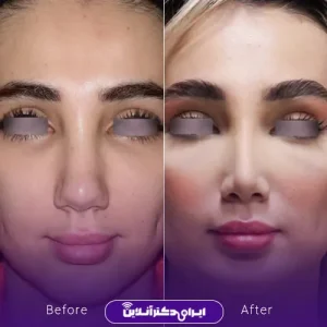 نمونه کار عمل بینی دکتر آرش نجف بیگی 3