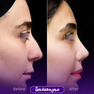 نمونه کار عمل بینی دکتر آرش نجف بیگی 4