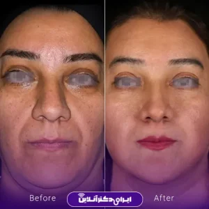 نمونه کار عمل بینی دکتر آرش نجف بیگی 5