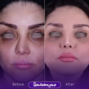 نمونه کار عمل بینی دکتر آرش نجف بیگی 6