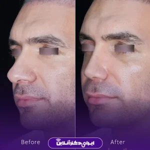 نمونه کار عمل بینی دکتر آرش نجف بیگی 7