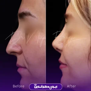 نمونه کار عمل بینی دکتر آرش نجف بیگی 8