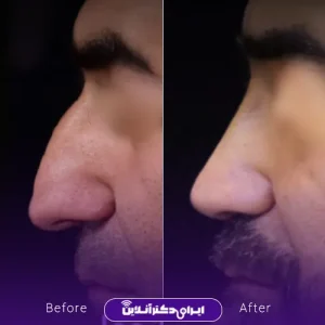 نمونه کار عمل بینی دکتر آرش نجف بیگی 9