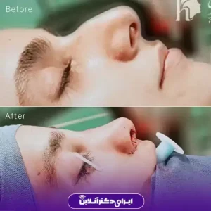 نمونه کار عمل بینی استخوانی دکتر کمال هادی 1