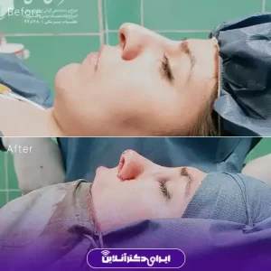 نمونه کار عمل بینی استخوانی دکتر کمال هادی 2