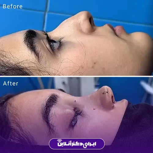 بهترین جراح بینی استخوانی در تهران + لیست 8 پزشک متخصص 119 نمونه کار عمل بینی دکتر خسرو مقتدر 4