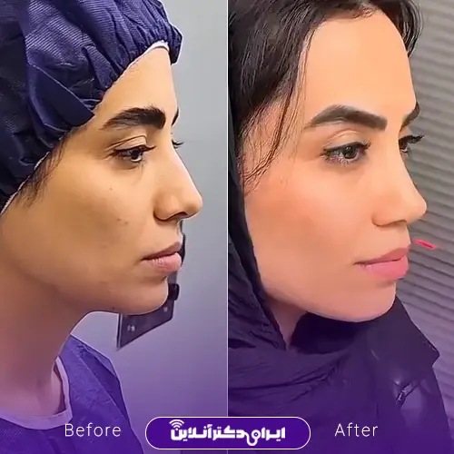 بهترین جراح بینی استخوانی در تهران + لیست 8 پزشک متخصص 120 نمونه کار عمل بینی دکتر خسرو مقتدر 5