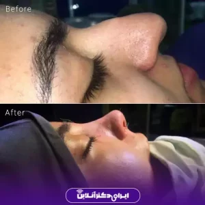نمونه کار عمل بینی دکتر مریم عبداللهی 1