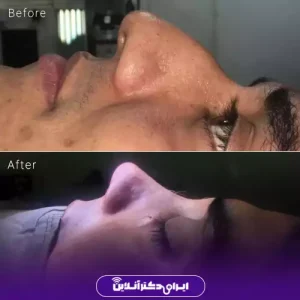 نمونه کار عمل بینی دکتر مریم عبداللهی 2