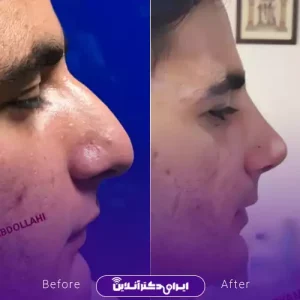 نمونه کار عمل بینی دکتر مریم عبداللهی 3