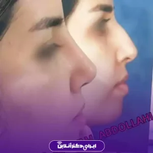 نمونه کار عمل بینی دکتر مریم عبداللهی 7