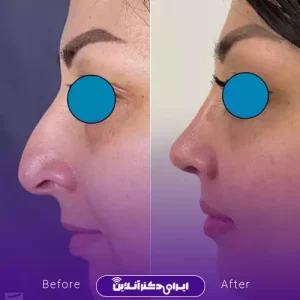 نمونه کار عمل بینی دکتر سعید گل پروران 1