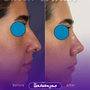 نمونه کار عمل بینی دکتر سعید گل پروران 5
