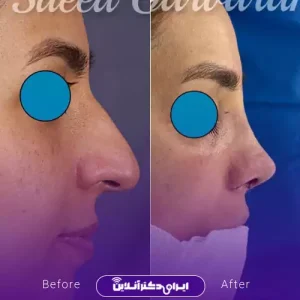 نمونه کار عمل بینی دکتر سعید گل پروران 7