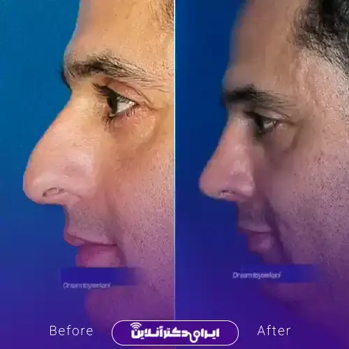 بهترین جراح بینی مردانه در تهران + لیست ۱۰ مورد از بهترین جراحان 99 نمونه کارهای عمل بینی مردانه دکتر سام تویسرکانی 3