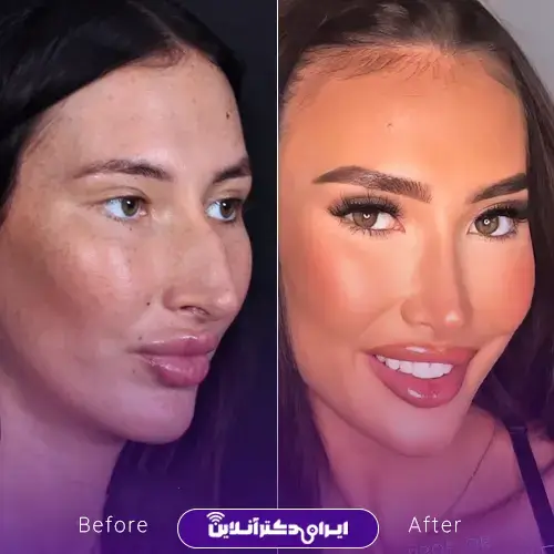 عمل بینی به روش اروپایی؛ عمل بینی اروپایی به چه صورتهایی میاد؟ 10 عمل بینی اروپایی برای صورتهای کشیده و استخوانی