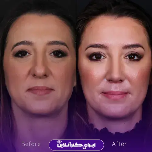 عمل بینی به روش اروپایی؛ عمل بینی اروپایی به چه صورتهایی میاد؟ 9 عمل بینی اروپایی برای صورت بیضی
