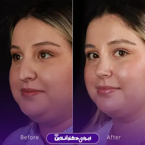 عمل بینی به روش اروپایی؛ عمل بینی اروپایی به چه صورتهایی میاد؟ 11 عمل بینی اروپایی برای صورتهای گرد