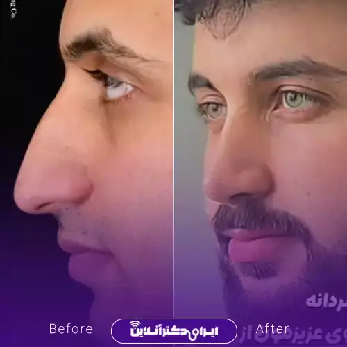 بهترین جراح بینی مردانه در تهران + لیست ۱۰ مورد از بهترین جراحان 123 نمونه کارهای عمل بینی مردانه دکتر امیر دریانی 1