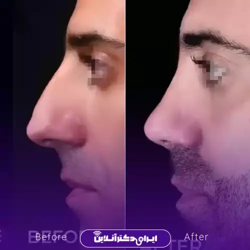 بهترین جراح بینی مردانه در تهران + لیست ۱۰ مورد از بهترین جراحان 126 نمونه کارهای عمل بینی مردانه دکتر امیر دریانی 4