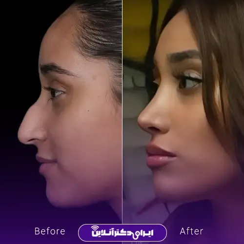 عمل بینی به روش اروپایی؛ عمل بینی اروپایی به چه صورتهایی میاد؟ 4 چگونه جراح مناسب برای عمل بینی اروپایی را انتخاب کنیم