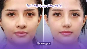 چگونه پرههای بینی را کوچک کنیم