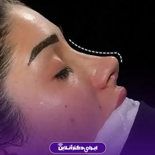 عمل بینی به روش اروپایی؛ عمل بینی اروپایی به چه صورتهایی میاد؟ 5 ویژگیهای ظاهری بینی اروپایی برای پل بینی