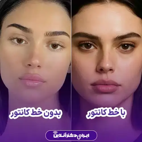 خط کانتور در عمل بینی کی مشخص میشود؟ 3 عمل بینی با خط کانتور و بدون خط کانتور؛ تفاوت در چیست؟