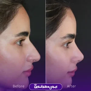 نمونه کار عمل بینی دکتر فرشته عصمتی نیا 1