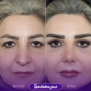 نمونه کار عمل بینی دکتر فرشته عصمتی نیا 2