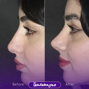 نمونه کار عمل بینی دکتر فرشته عصمتی نیا 3