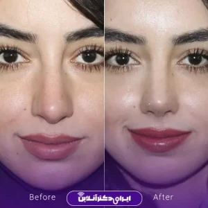 نمونه کار عمل بینی دکتر فرشته عصمتی نیا 4