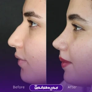 نمونه کار عمل بینی دکتر فرشته عصمتی نیا 5