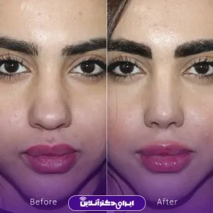 نمونه کار عمل بینی دکتر فرشته عصمتی نیا 6