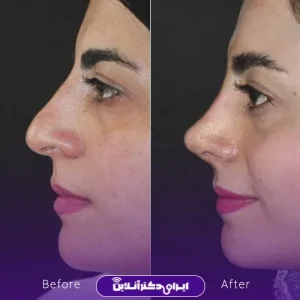 نمونه کار عمل بینی دکتر فرشته عصمتی نیا 7