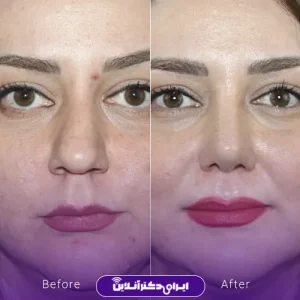 نمونه کار عمل بینی دکتر فرشته عصمتی نیا 8