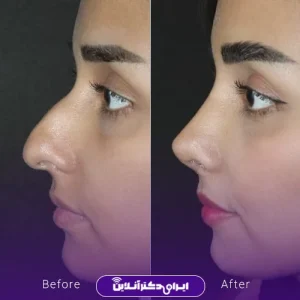 نمونه کار عمل بینی دکتر فرشته عصمتی نیا 9