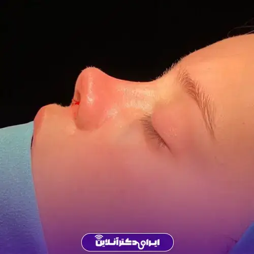 عمل بینی به روش اروپایی؛ عمل بینی اروپایی به چه صورتهایی میاد؟ 3 عمل بینی به روش اروپایی چیست