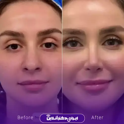 خط کانتور در عمل بینی کی مشخص میشود؟ 2 What is the contour line in rhinoplasty?