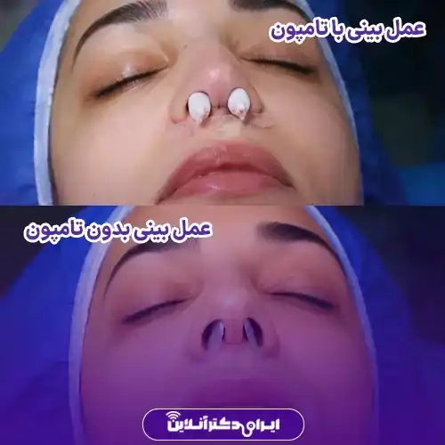 عمل بینی بدون تامپون چگونه است؟ آیا حذف تامپون کیفیت عمل را کاهش میدهد؟ 2 در عمل بینی بدون تامپون به جای تامپون از چه چیزی استفاده میشود