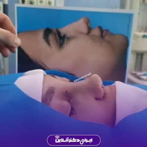 بهترین جراح بینی فانتزی در تهران (لیست 10 پزشک برتر + نمونه کار) 137 نمونه کار قبل و بعد عمل بینی فانتزی دکتر اکبر اعتمادی 1