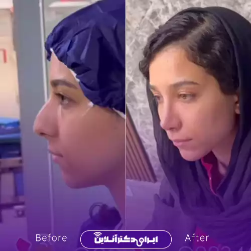 بهترین جراح بینی فانتزی در تهران (لیست 10 پزشک برتر + نمونه کار) 138 نمونه کار قبل و بعد عمل بینی فانتزی دکتر اکبر اعتمادی 2