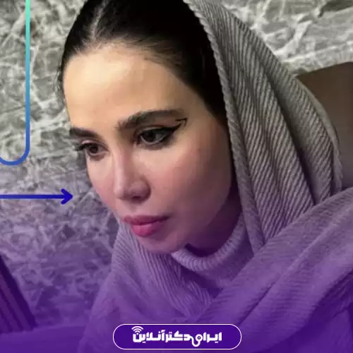 بهترین جراح بینی فانتزی در تهران (لیست 10 پزشک برتر + نمونه کار) 140 نمونه کار قبل و بعد عمل بینی فانتزی دکتر اکبر اعتمادی 4