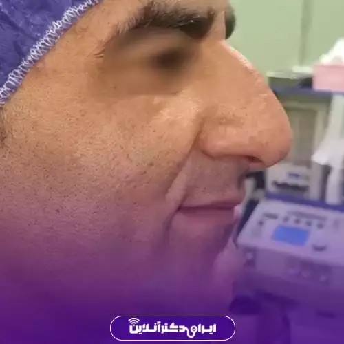 عمل بینی قوزدار و عقابی؛ راهنمای جامع جراحی بینی قوزدار 3 قوز ترکیبی (استخوانی-غضروفی)