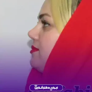 نمونه کار عمل بینی دکتر ابراهیم فهیم نیا 10