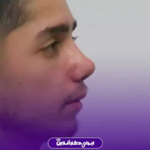 نمونه کار عمل بینی دکتر ابراهیم فهیم نیا 3