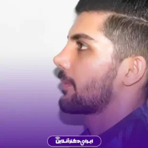 نمونه کار عمل بینی دکتر ابراهیم فهیم نیا 9