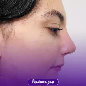 نمونه کار عمل بینی دکتر فرهام احمدی 1