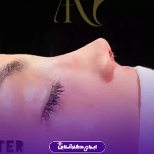 نمونه کار عمل بینی دکتر فرهام احمدی 3