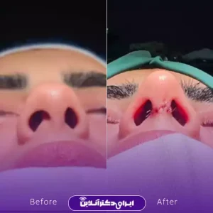 نمونه کار عمل بینی دکتر فرهام احمدی 5
